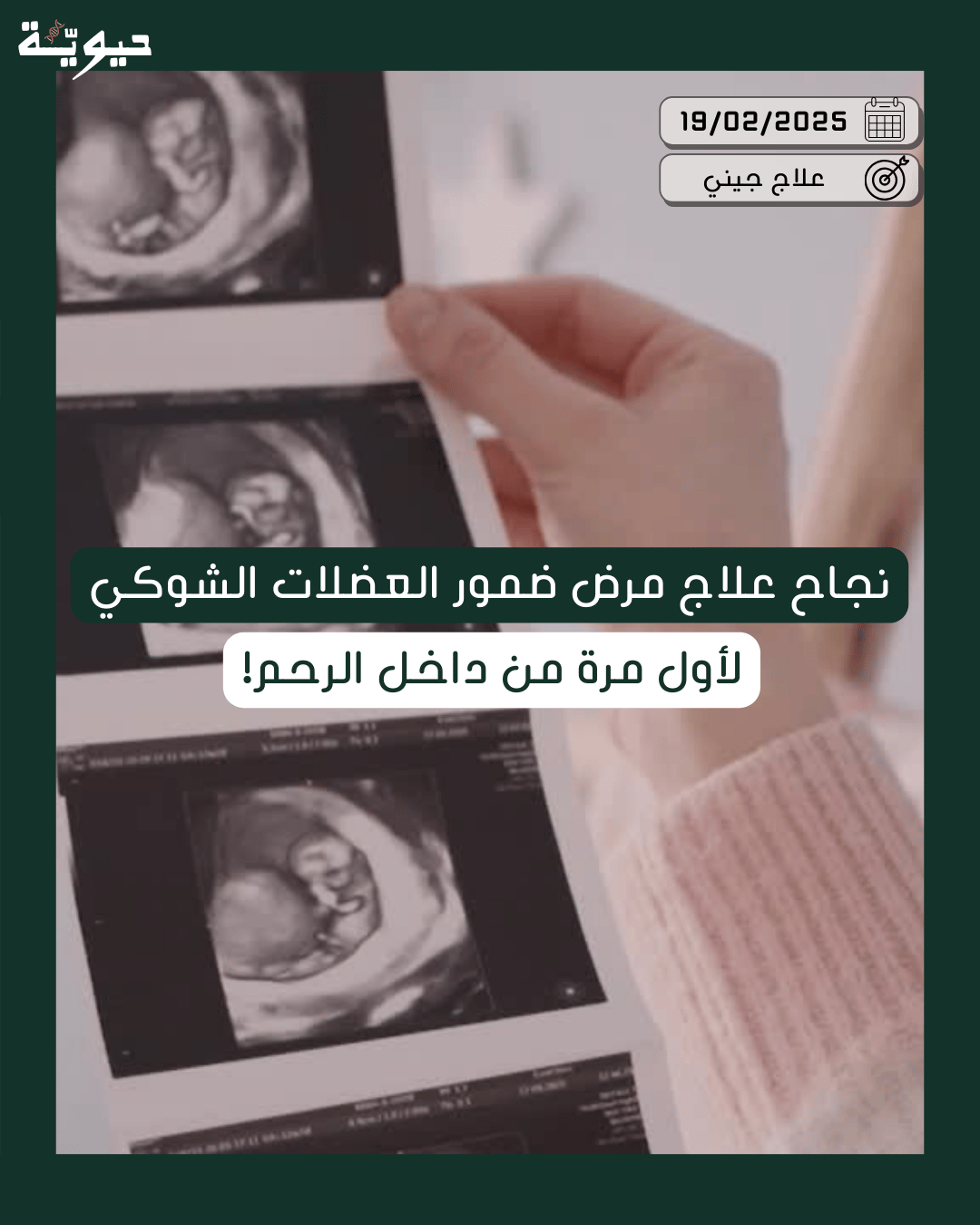 نجاح علاج مرض ضمور العضلات الشوكي.. لأول مرة من داخل الرحم!